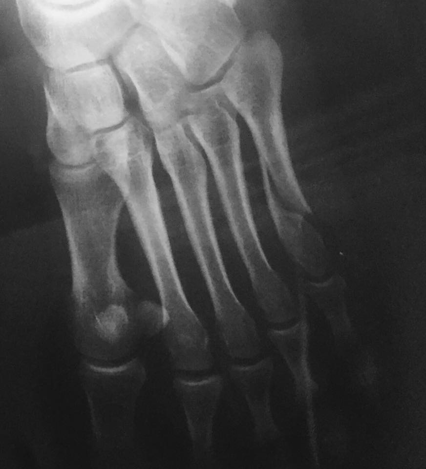 Article : De la patience, ou: les joies de la cinquième métatarse